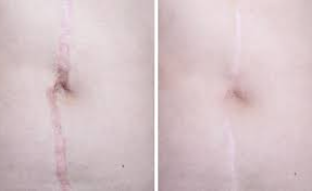 Advanced scar revision techniques